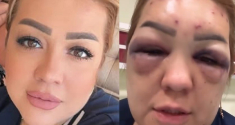 Botoks Bu Hale Getirdi: Yüzü Şişti Tanınmayacak Hale Geldi