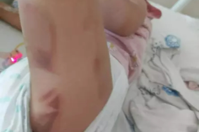 AMELİYAT SONRASI SKANDAL: MİNİK YAREN YANIK İZLERİYLE ÇIKTI