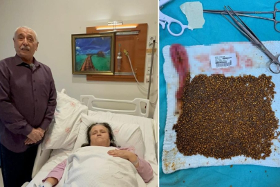 KADINDAN 20 BİN ADET TAŞ ÇIKARILDI: DOKTORLAR ŞOKA UĞRADI