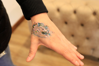 DÖVMESİNİ SİLDİRMEK İSTEYEN GENCİN ELİNDEKİ DOKULAR DÖKÜLDÜ