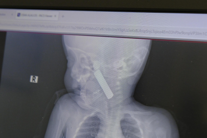 BOĞAZINA KUMANDA PİLİ KAÇAN BEBEK ÖLÜMDEN DÖNDÜ