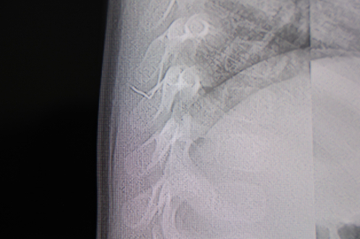 BİR YAŞINDAKİ BEBEĞİN SIRTINDAN 2 SANTİMETRELİK TEL ÇIKTI