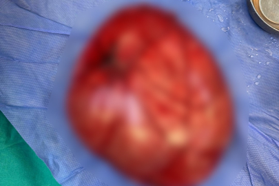 ÇOCUĞUN KARNINDAN 3,5 KİLOLUK KİST ÇIKTI